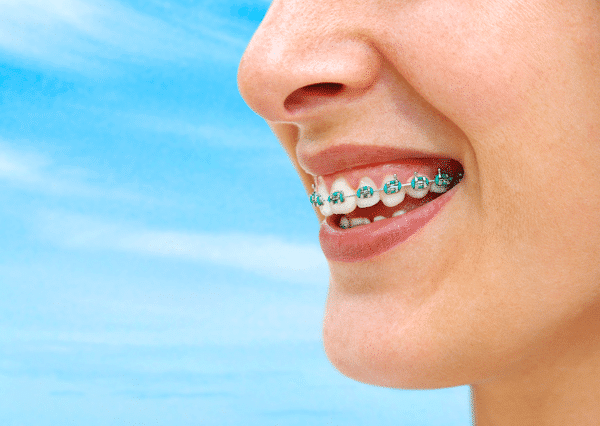 Woman With braces