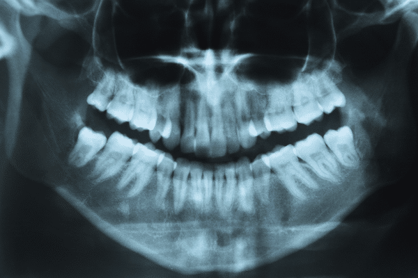xray-of-teeth
