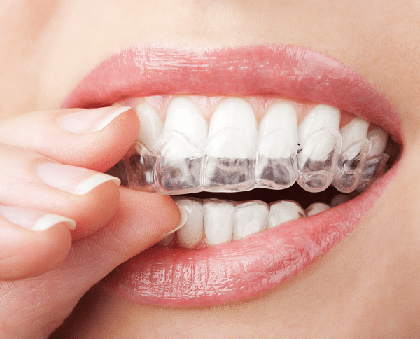 how much does invisalign cost clinton hill ny