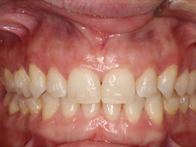 Hanson Place Orthodontics Virtual Consultation Front Smile