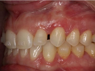 Hanson Place Orthodontics Virtual Consultation Left Smile