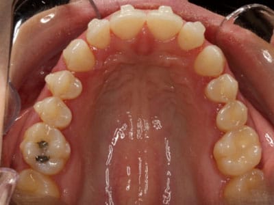 Hanson Place Orthodontics Virtual Consultation Top Smile