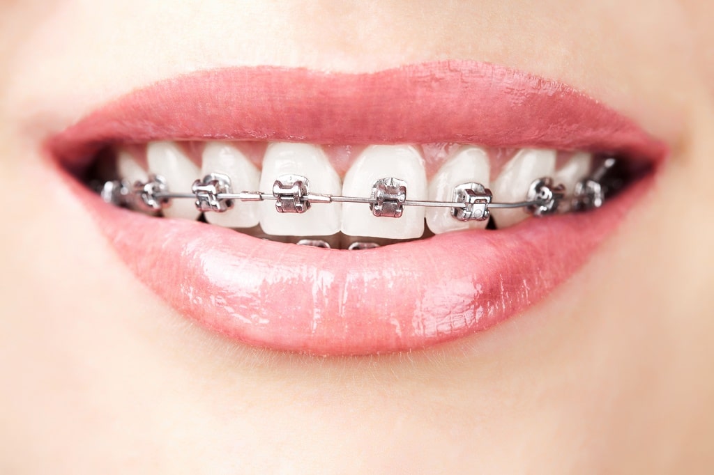 Difference Between Braces and Clear Braces