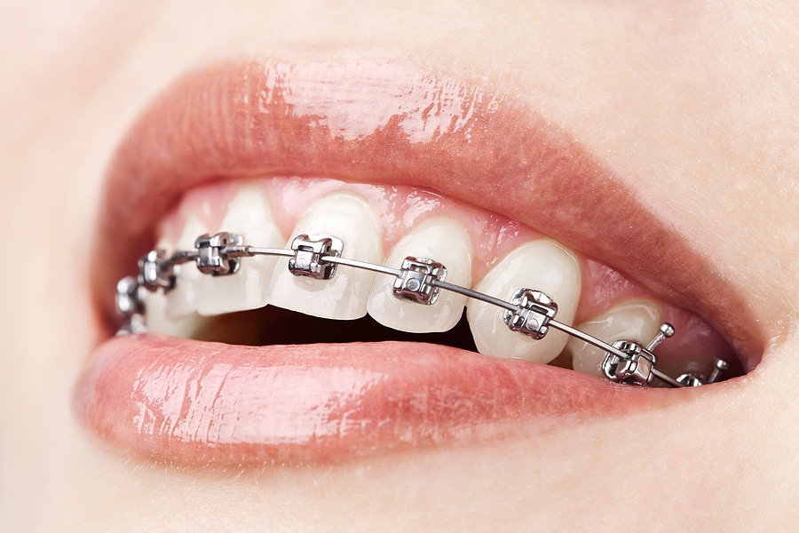 Orthodontics – Braces & Lingual Braces (invisible) - Advanced