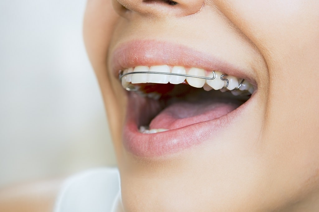 Close up of a woman mouth with a different type of braces on. 