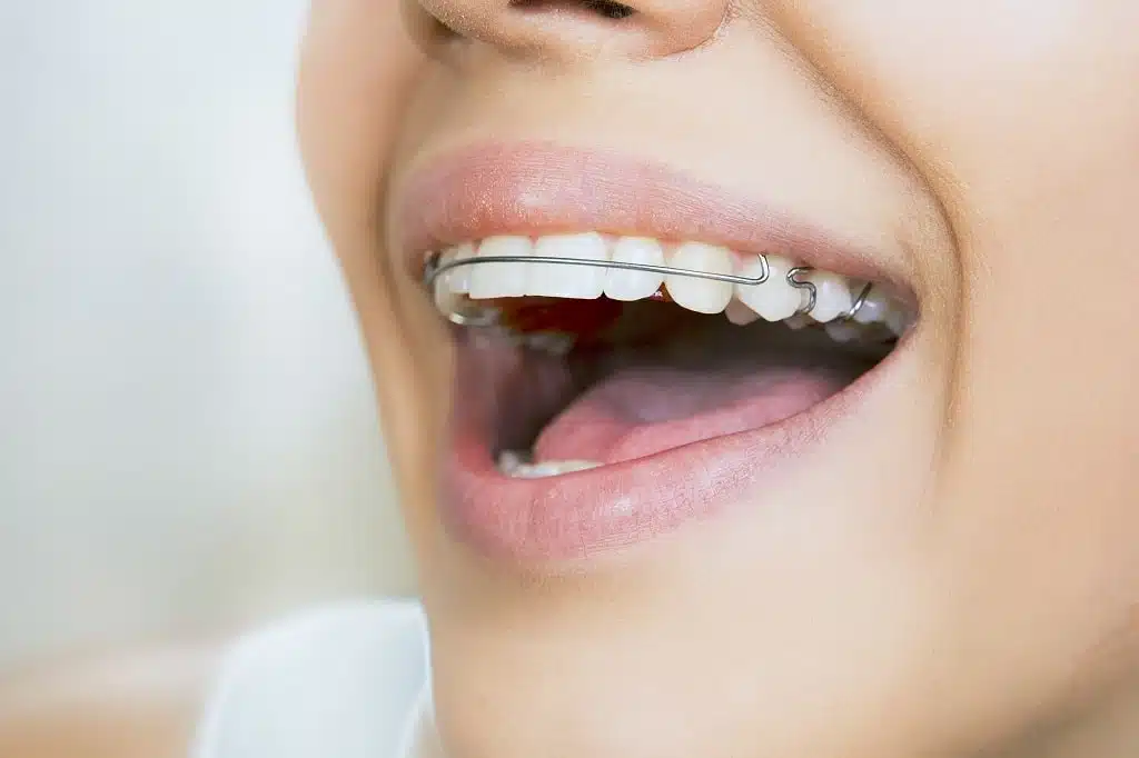 Close up of a woman mouth with a different type of braces on.