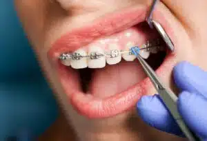 Braces in Brooklyn Ny Braces in Brooklyn NY