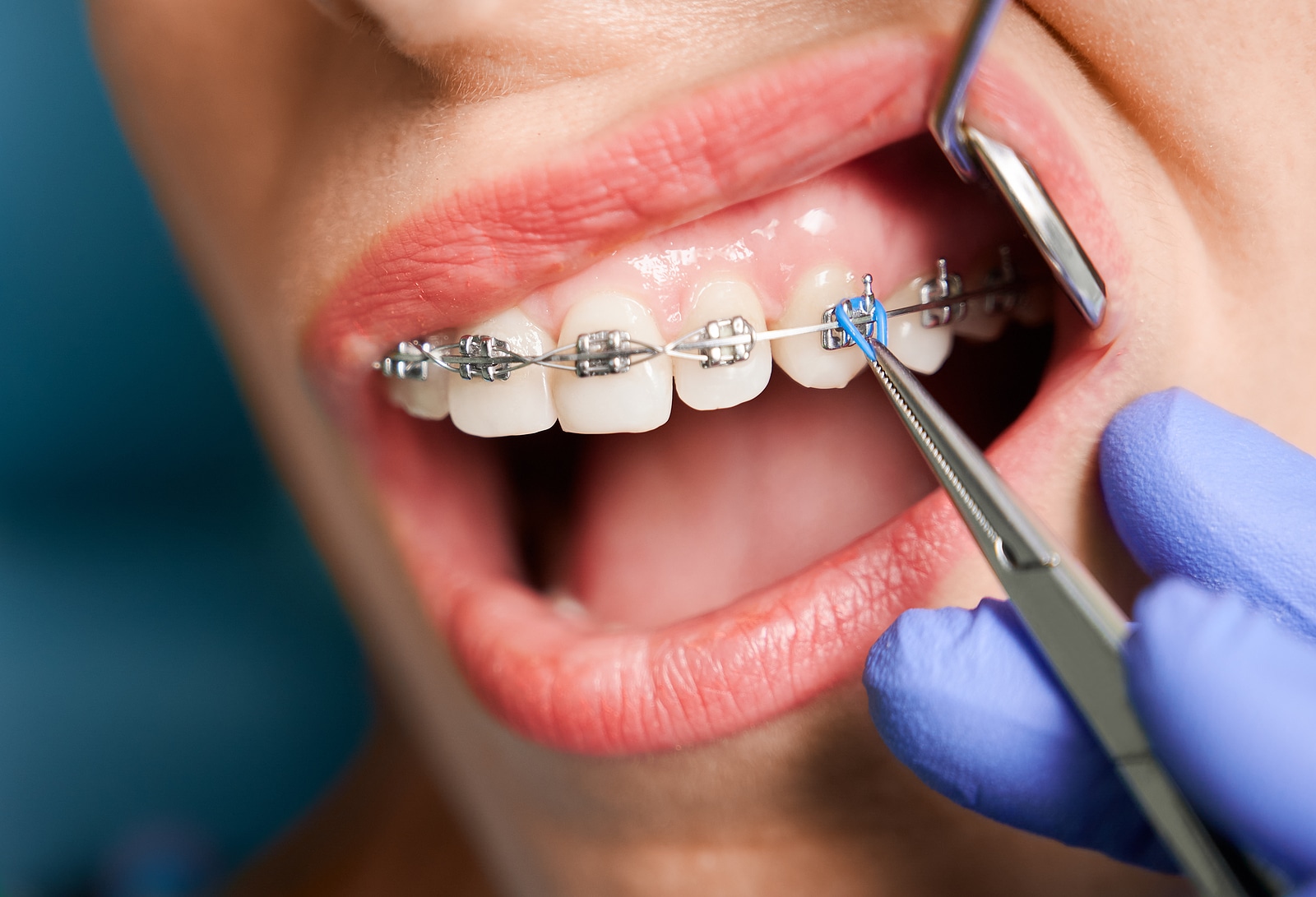 Commonly Asked Questions About Tooth Jewelry - Aces Braces