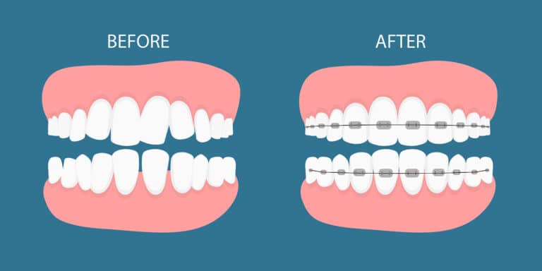 An illustration of what teeth might look like before and after braces