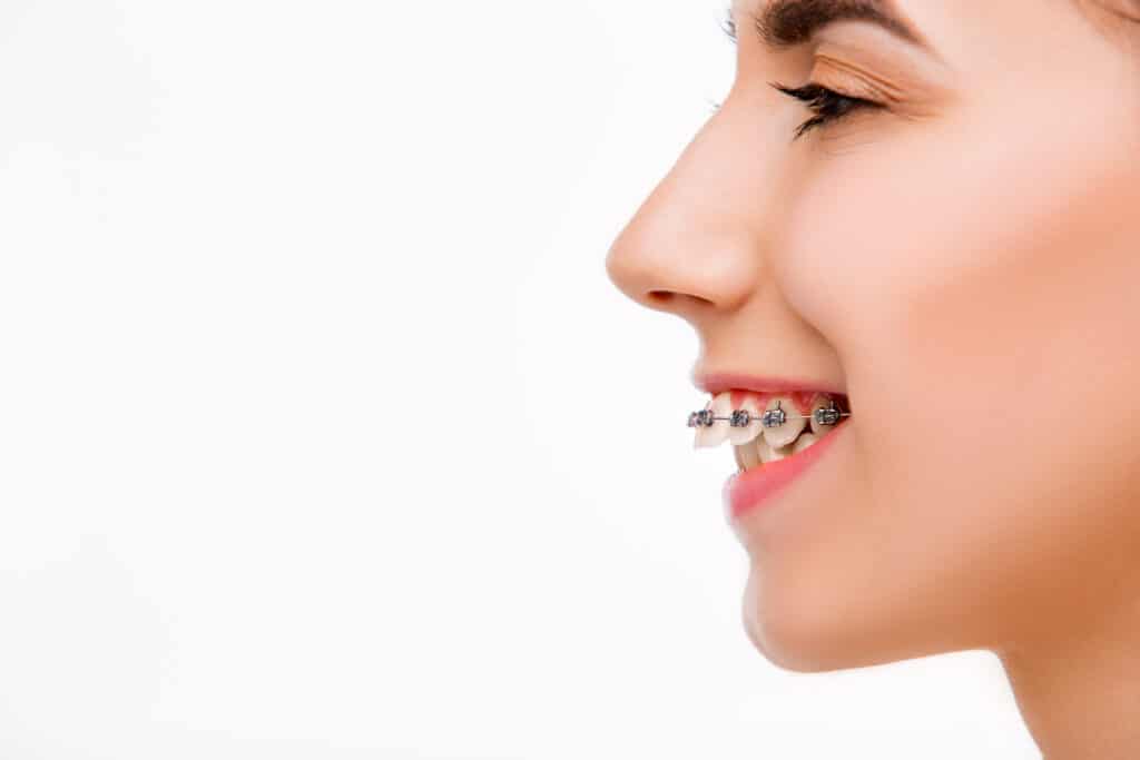 Will My Orthodontic Treatment Fix Overbite Hanson Place Orthodontics
