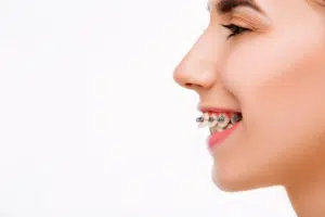 Orthodontist Brooklyn Ny. Orthodontic Treatment Fix Overbite