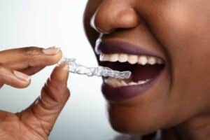 adult orthodontic treatment