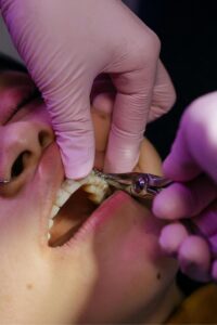 Teeth Hurt After Getting Braces Off