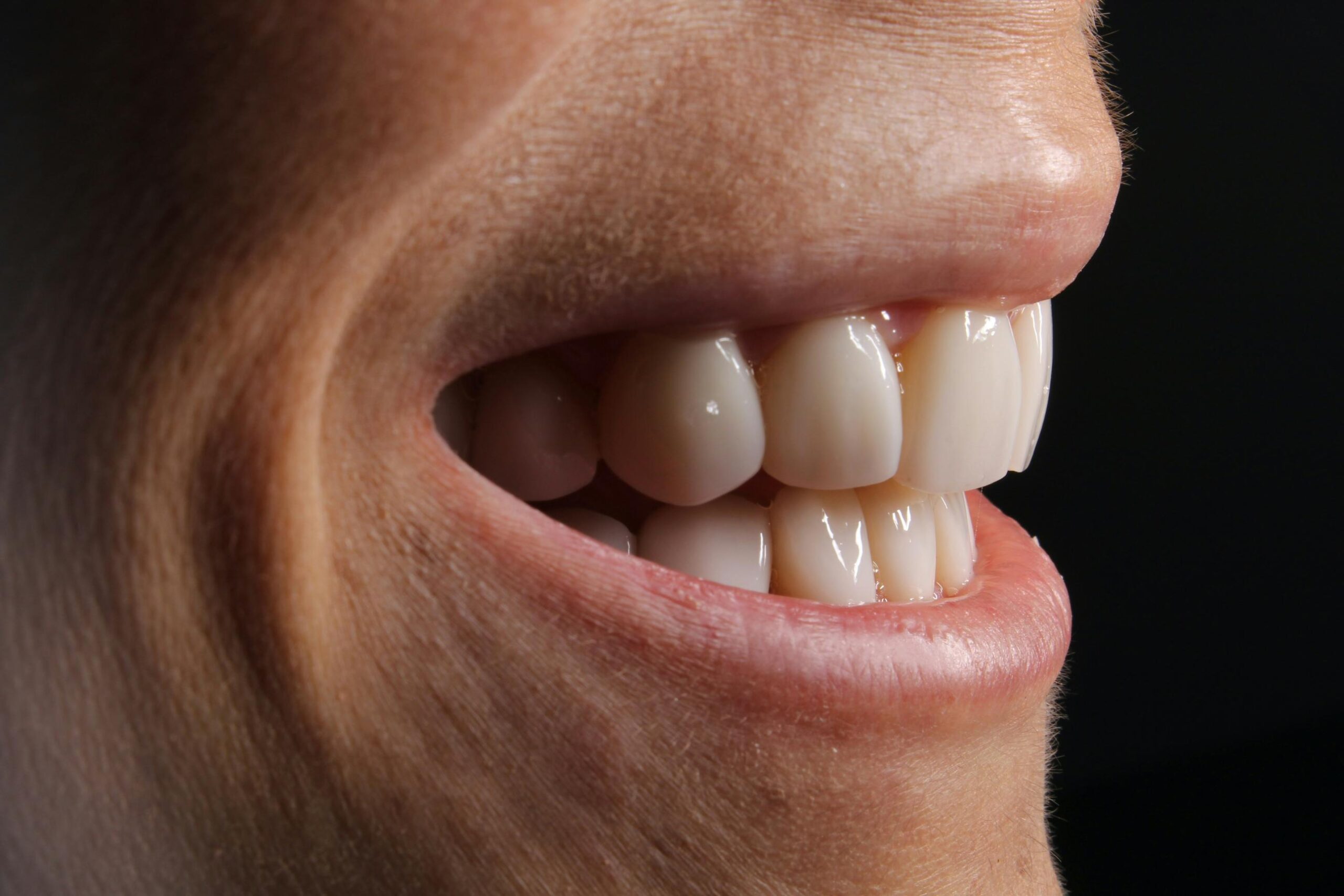 Teeth Hurt After Getting Braces Off? Expert Tips for Quick Relief