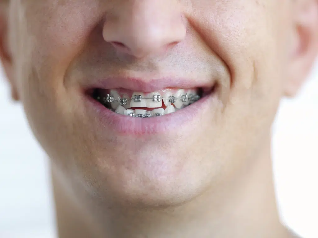 Do Braces Change Your Face Truth Behind Changes