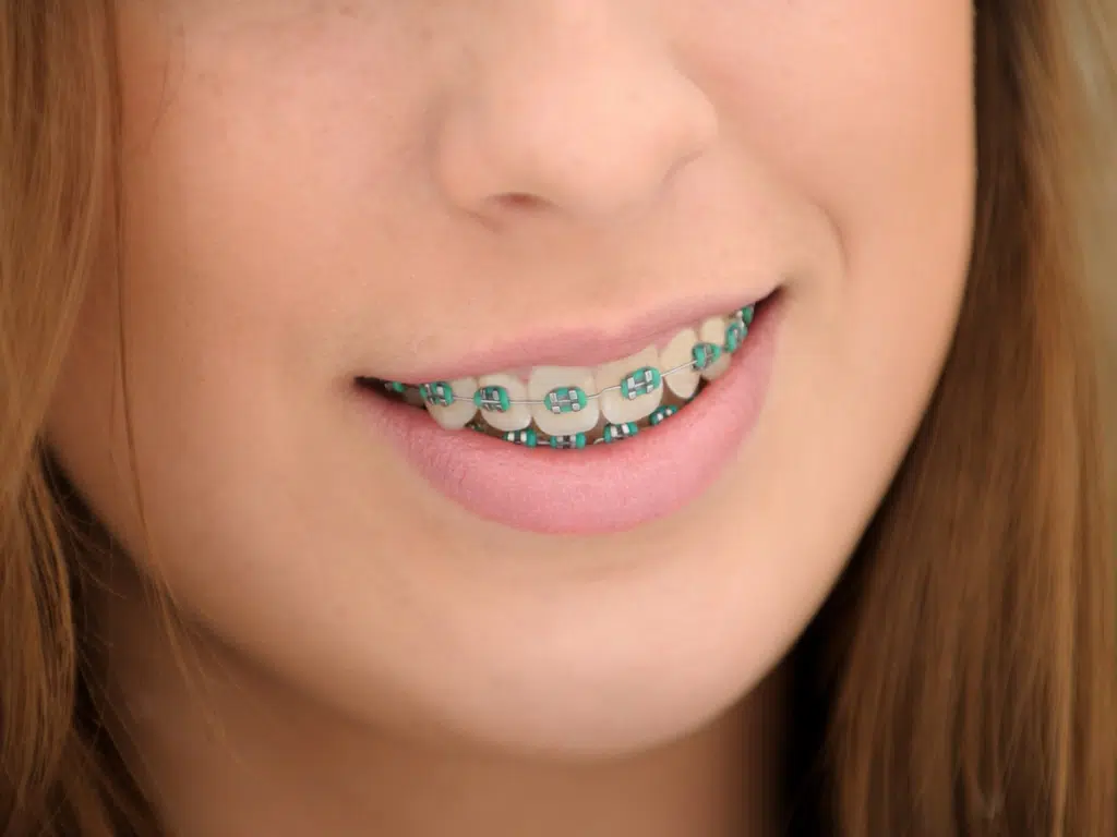 Orthodontic Jawline Changes Guide