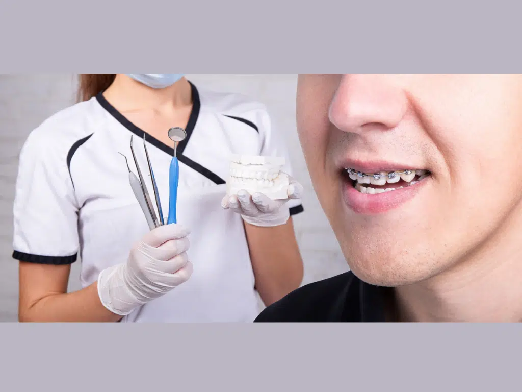 Benefits of Braces for Facial Balance