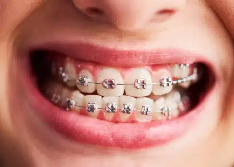 Close-up of teeth with braces showing alignment improvement related to facial symmetry