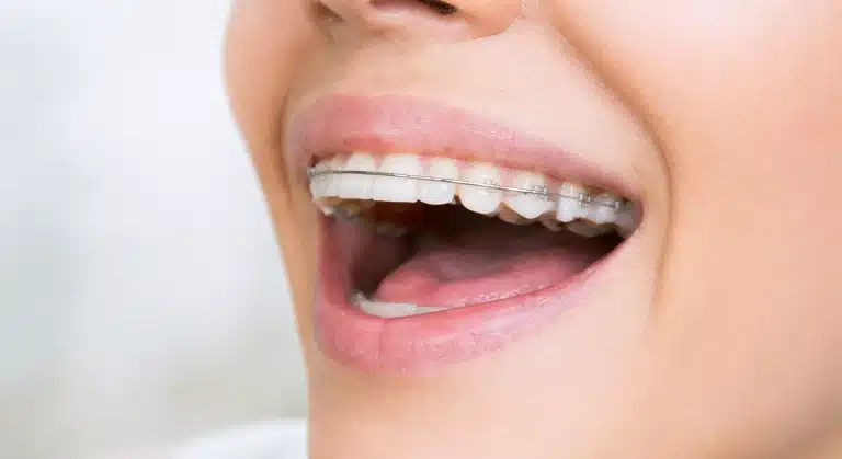 Beautiful teenage girl smiling while wearing a clear dental retainer