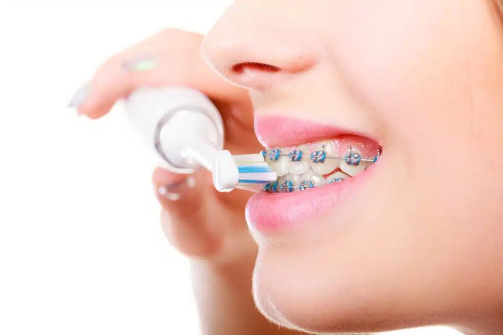 A close-up of a patient using an electric toothbrush to clean teeth with metal braces and blue bands