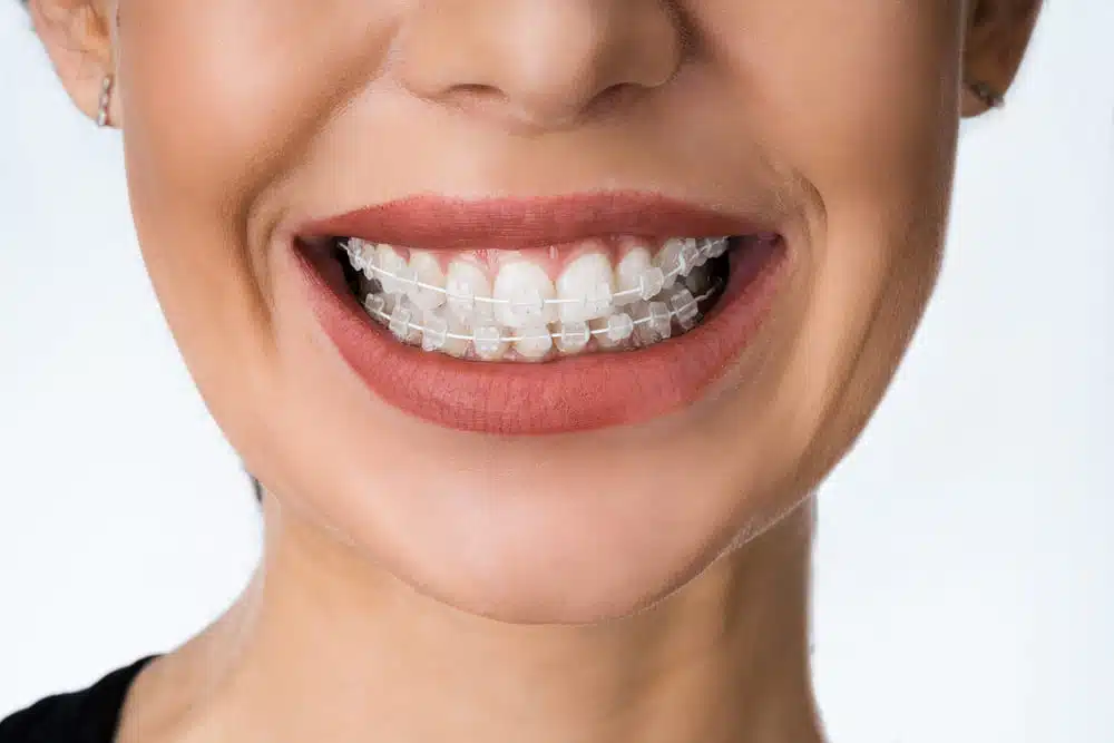 LightForce braces Brooklyn NY
