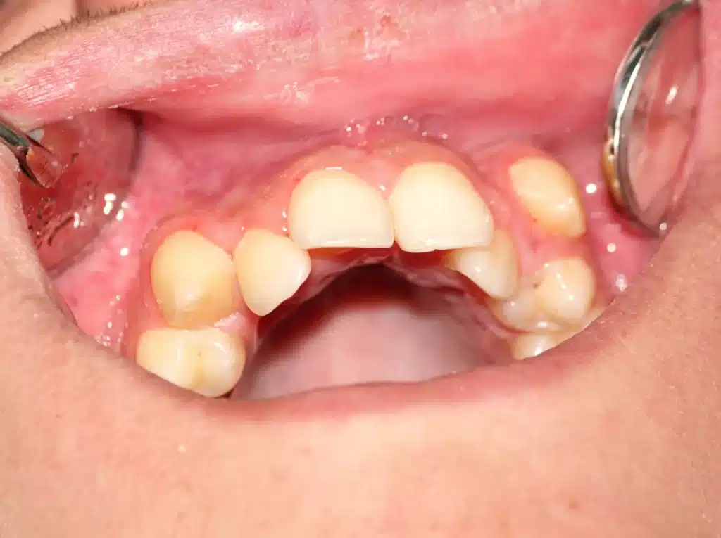 Extreme crowding of the upper teeth