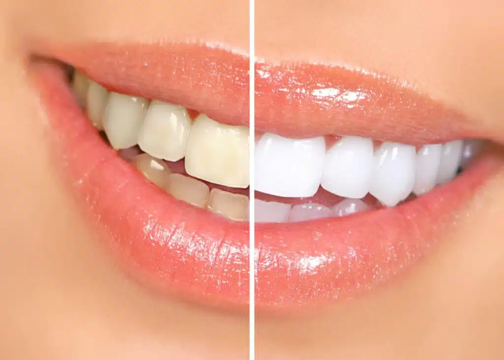 Before and after comparison of a woman's yellow teeth after invisalign