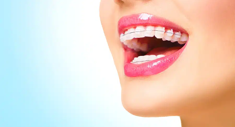 Close-up of a smile with clear ceramic braces